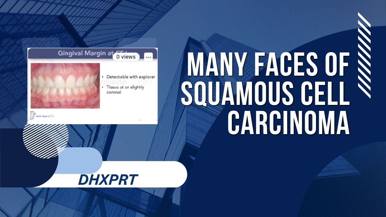 The Many Faces of Squamous Cell Carcinoma
